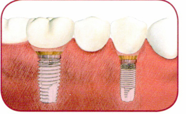 Implants dentaires - Province de Liège